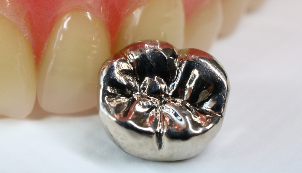 銀歯（金銀パラジウム合金）※保険適用