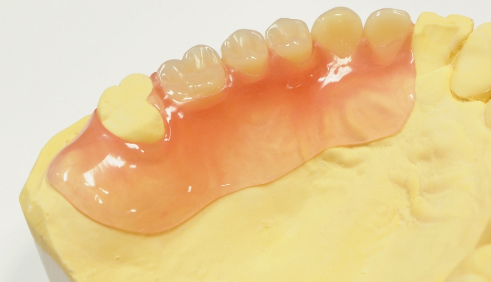 ノンクラスプデンチャー（自費）