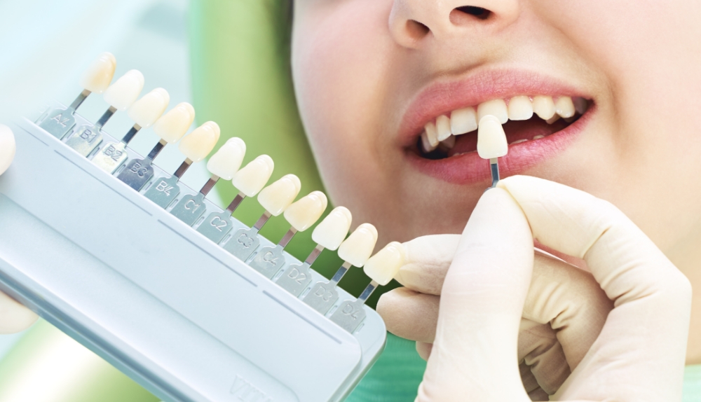 ホワイトニング